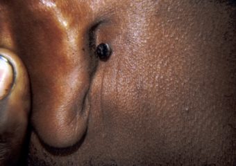 Pigmented BCC behind the ear