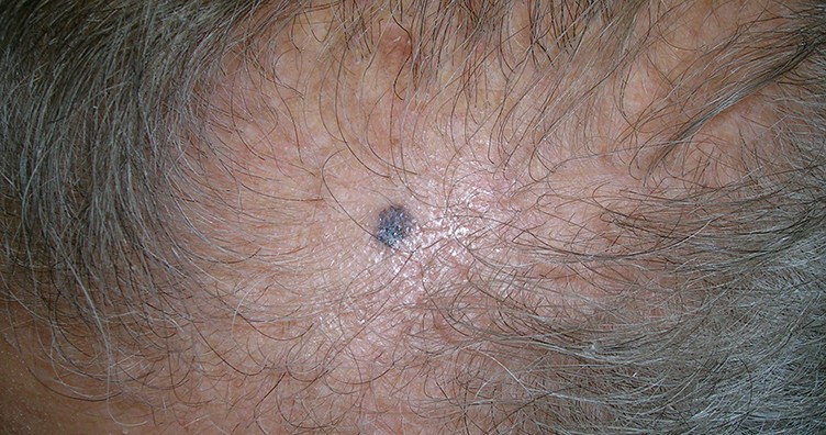 Carcinoma basocelular pigmentado en el cuero cabelludo