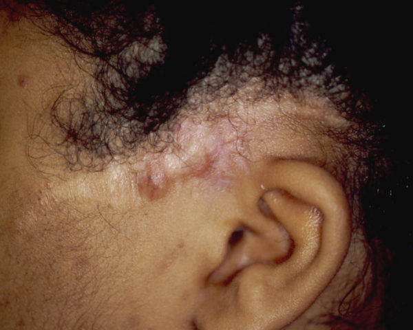 recurrent dermatfibrosarcoma protuberans