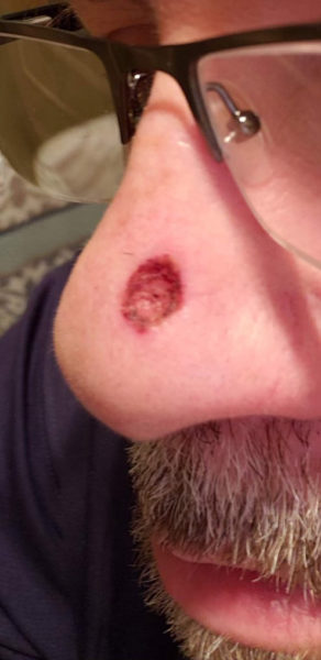 Picture of a man's nose after bcc treatment