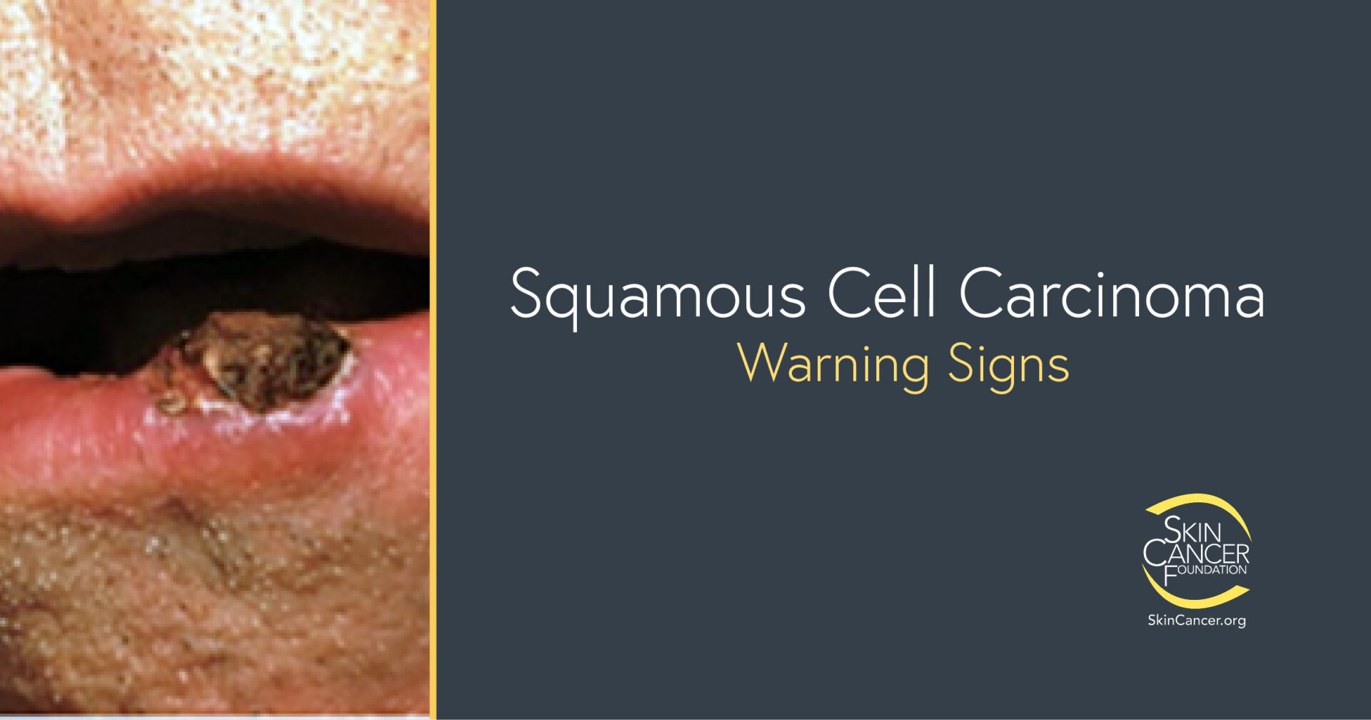 Squamous Cell Carcinoma Warning Signs and Images - The Skin Cancer ...