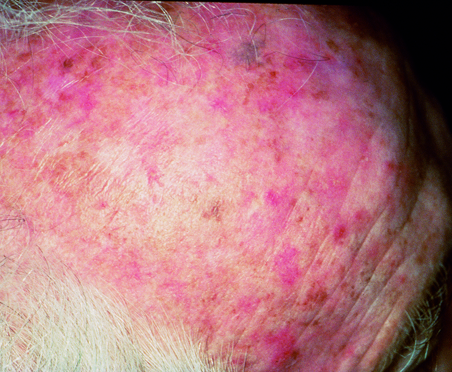 Actinic Keratosis Warning Signs And Images