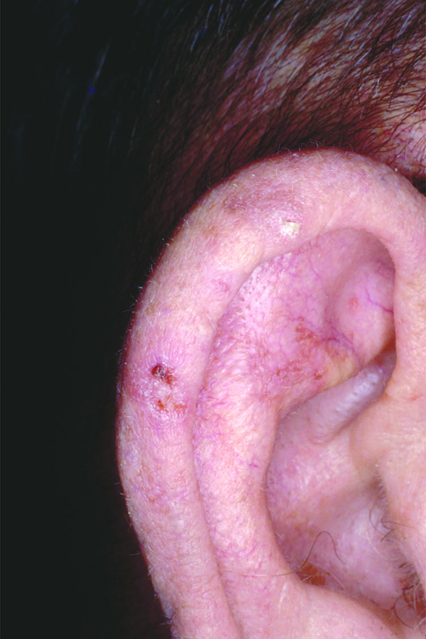 What Does Skin Cancer Look Like On A Toddler