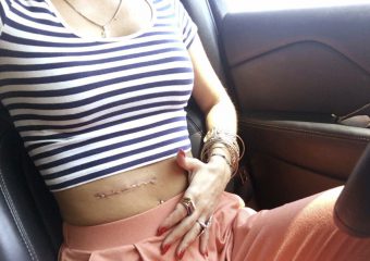 Cicatrice de mélanome sur l'abdomen