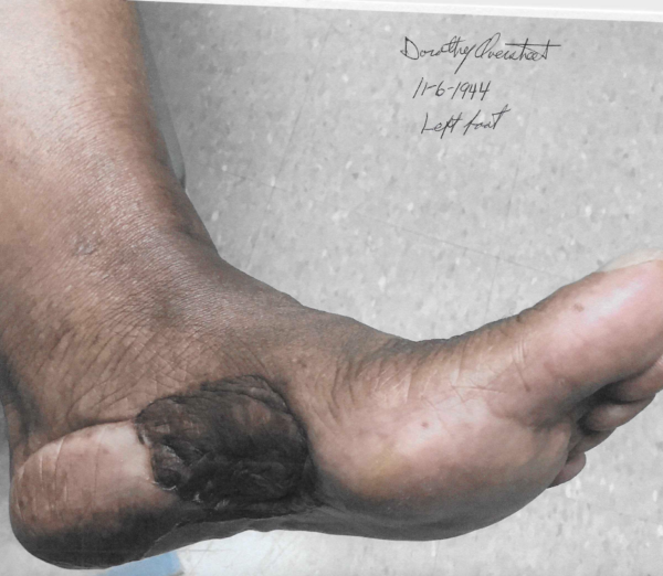 Acral lentiginous melanoma on left heel of Black woman