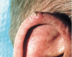 carcinome épidermoïde à croissance ressemblant à une verrue sur l'oreille