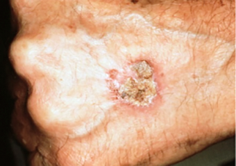 Patch on man hand squamous cell carcinoma
