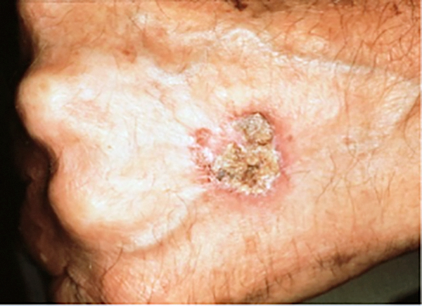 Le Carcinome Épidermoïde - The Skin Cancer Foundation