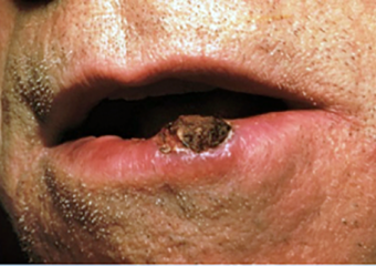 carcinome épidermoïde sur la lèvre