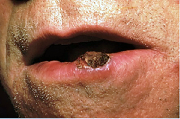 Squamous Cell Carcinoma Warning Signs And Images The Skin Cancer