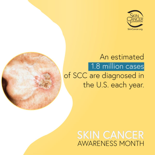 An estimated 1.8 million cases of SCC are diagnosed in the U.S. each year