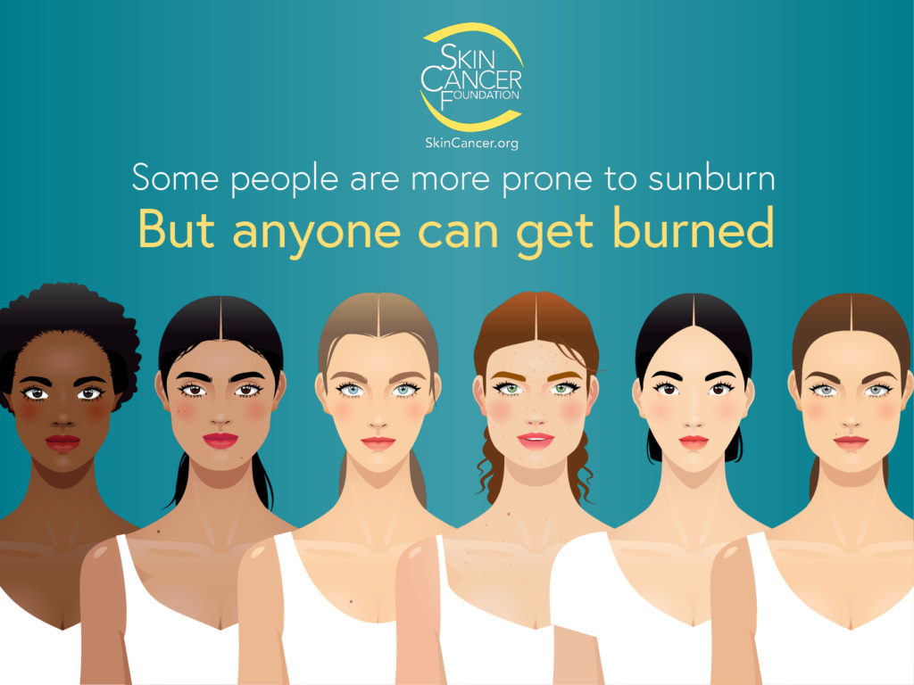 Some people are more prone to sunburn but anyone can get burned