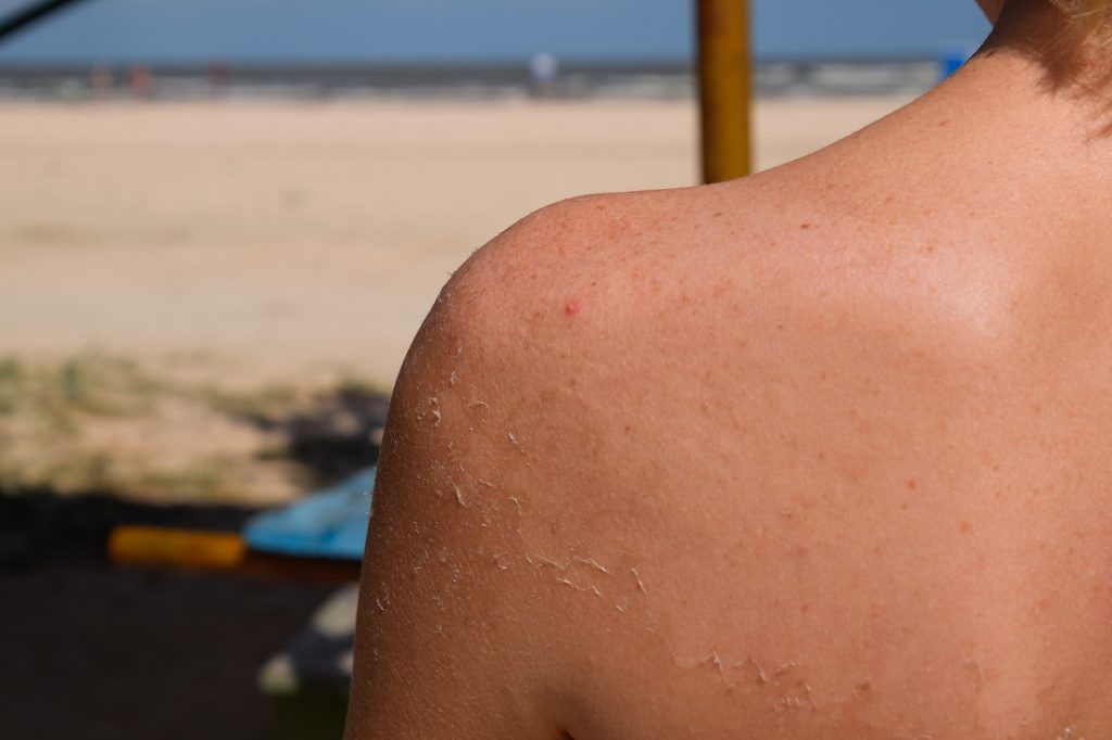 woman with peeling sunburn