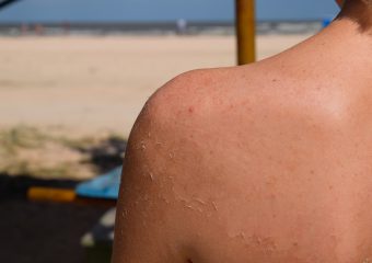 woman with peeling sunburn