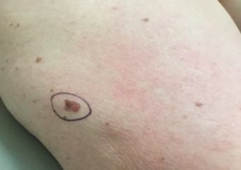 Superficial melanoma 0.55mm Upper Arm