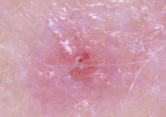 A nodular melanoma developing within an amelanotic melanoma in situ on the scalp.