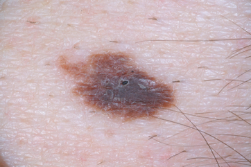 picture atypical mole