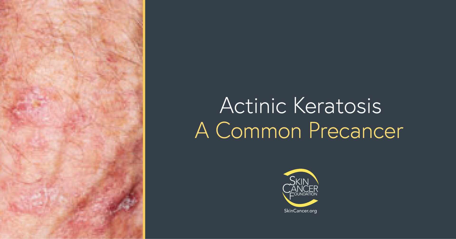 Actinic Keratosis - The Skin Cancer Foundation