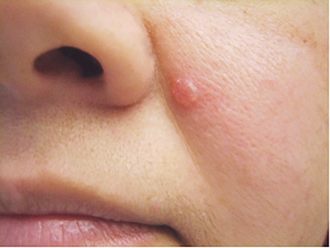 Basal Cell Carcinoma Warning Signs and Images - The Skin Cancer Foundation