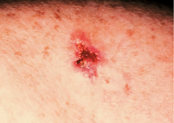 immagine ferita aperta sul carcinoma basocellulare della pelle