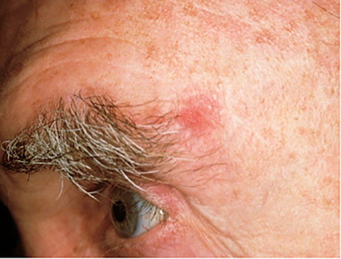 Basal Cell Skin Cancer On Nose Cancer Symptom