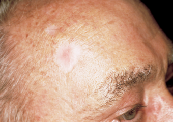 foto cicatrice bianca uomo fronte carcinoma basocellulare