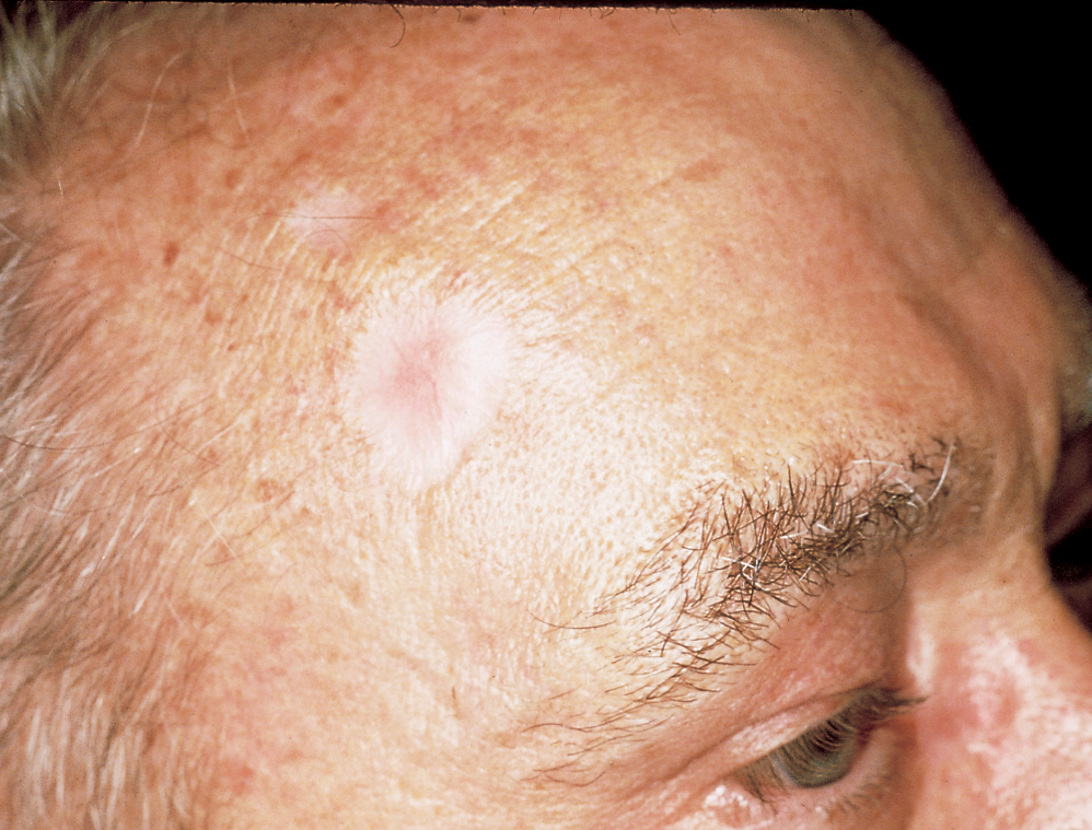 Basal Cell Carcinoma Pictures Scalp