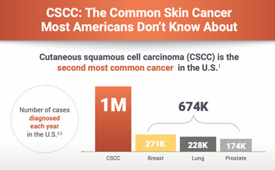 CSCC The Common Skin Cancer Most Americans Don't Know About