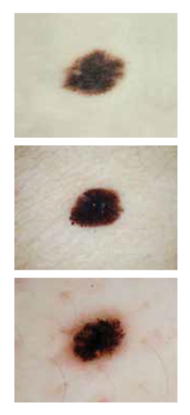 d is for dark melanoma - stack of images