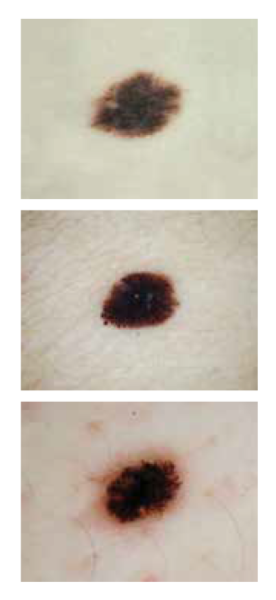 d is for dark melanoma - stack of images