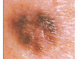 Naevus Dysplasiques Et Risque De Mélanome The Skin Cancer