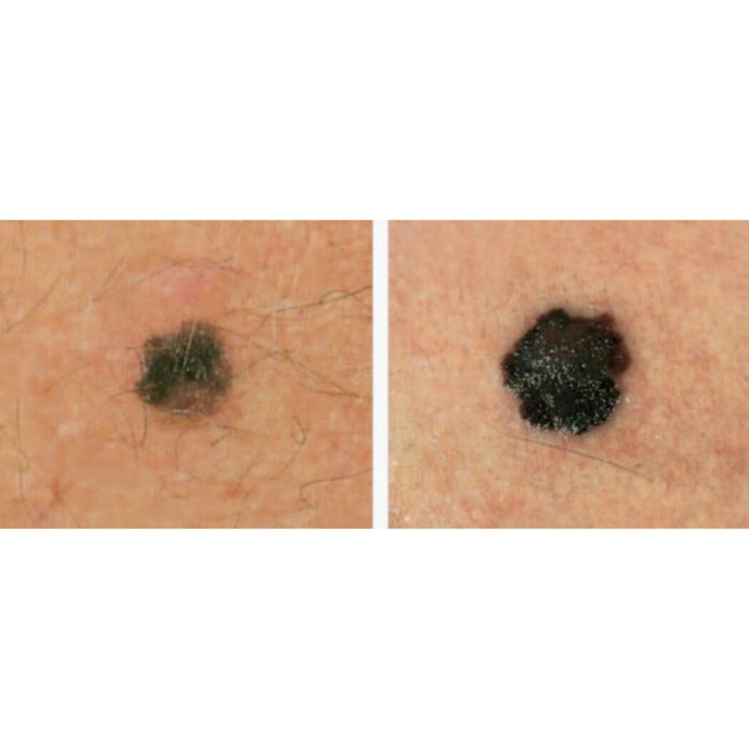 in evoluzione-melanoma-diario