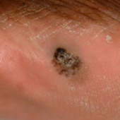 皮肤癌的迹象：肢端黑色素瘤