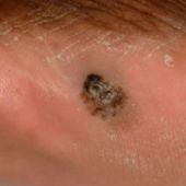 melanoma acral lentiginoso