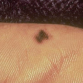 signs of skin cancer: acral lentiginous melanoma