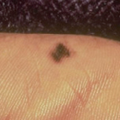 melanoma lentiginoso acral