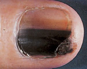 subungal melanoma