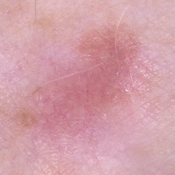 An example of a flat, amelanotic, superficial spreading melanoma on the leg.
