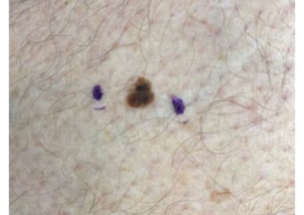 melanoma in situ 1 cm on the right calf