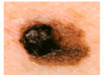 Picture of mole with asymmetry, melanoma warning sign