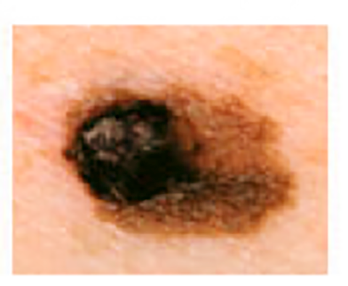 Picture of mole with asymmetry, melanoma warning sign