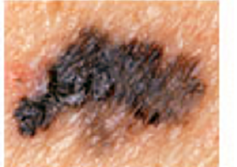 signs of skin cancer: melanoma with irregular border