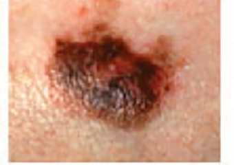 signs of skin cancer: melanoma with unconventional color