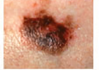 melanoma picture mole unconventional color