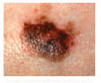 Skin Cancer Abcde Chart