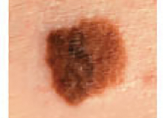 signs of skin cancer: dark melanoma with large diameter