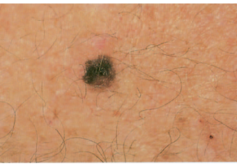 signs of skin cancer: melanoma evolving before photo