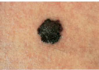 signs of skin cancer: melanoma evolving after photo