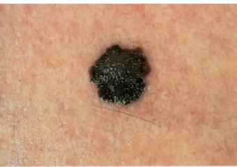 melanoma skin moles