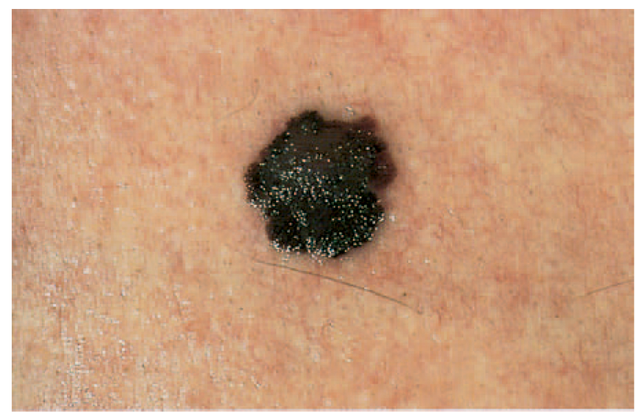 picture of melanoma evolving into bigger